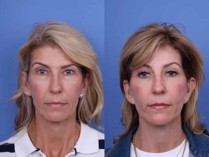 Before & After Facelift Case 695 Front View in Scottsdale, AZ