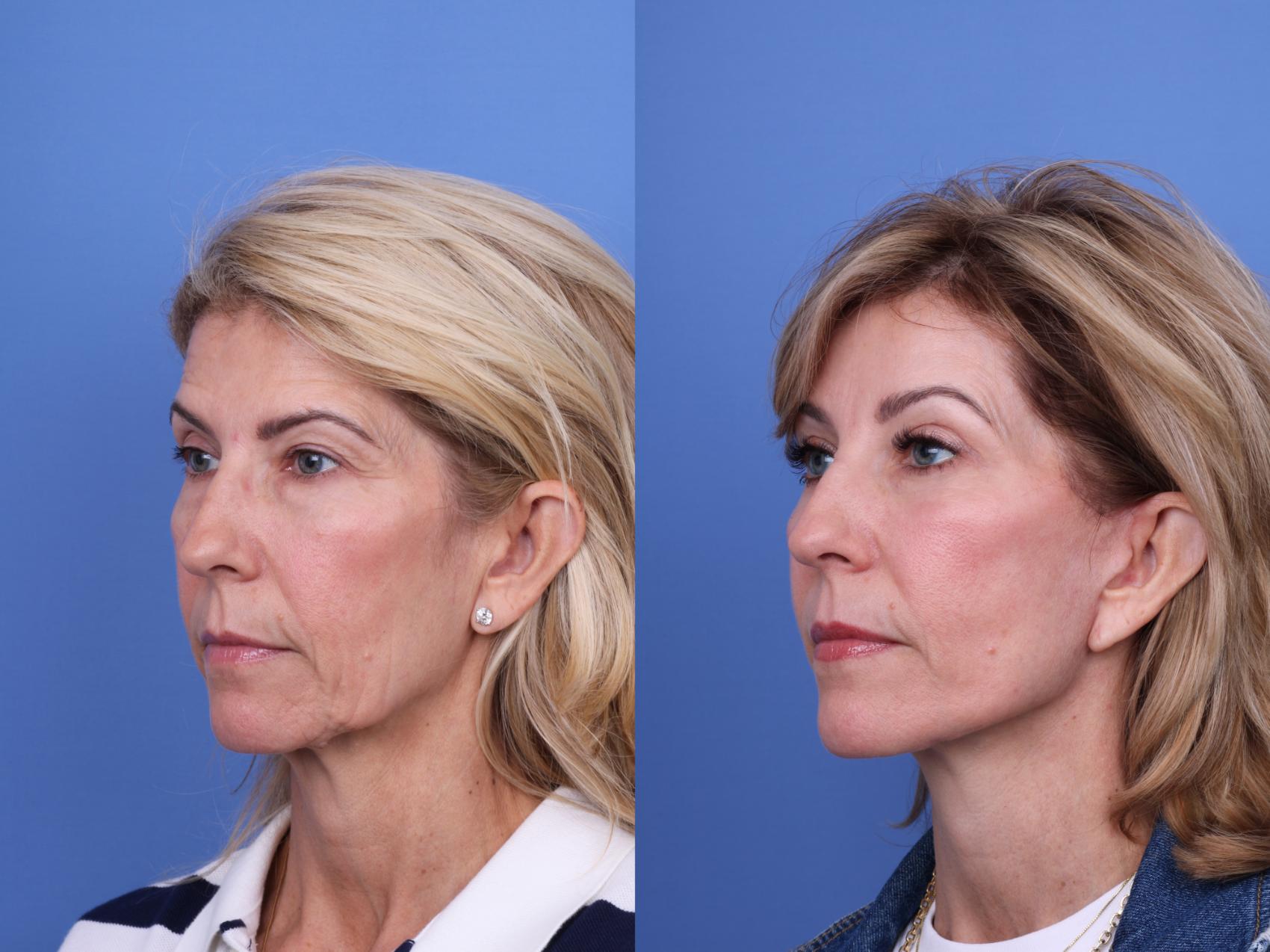 Before & After Facelift Case 695 Left Oblique View in Scottsdale, AZ