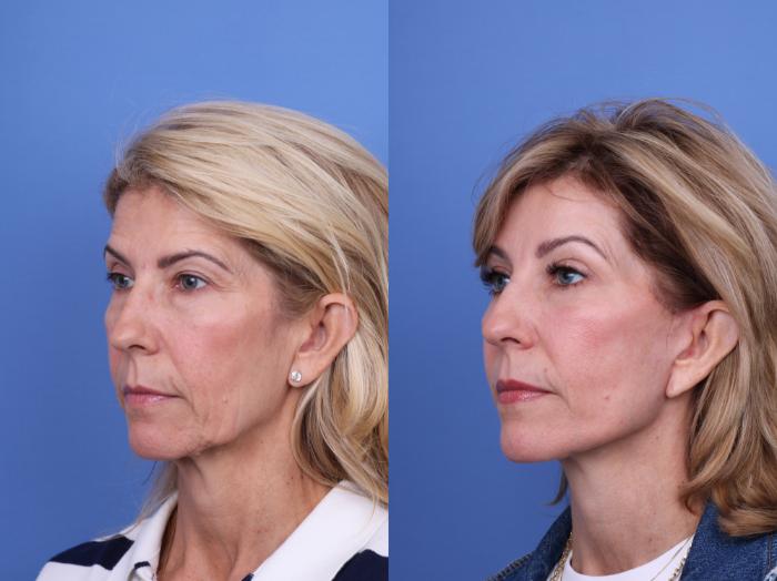 Before & After Facelift Case 695 Left Oblique View in Scottsdale, AZ