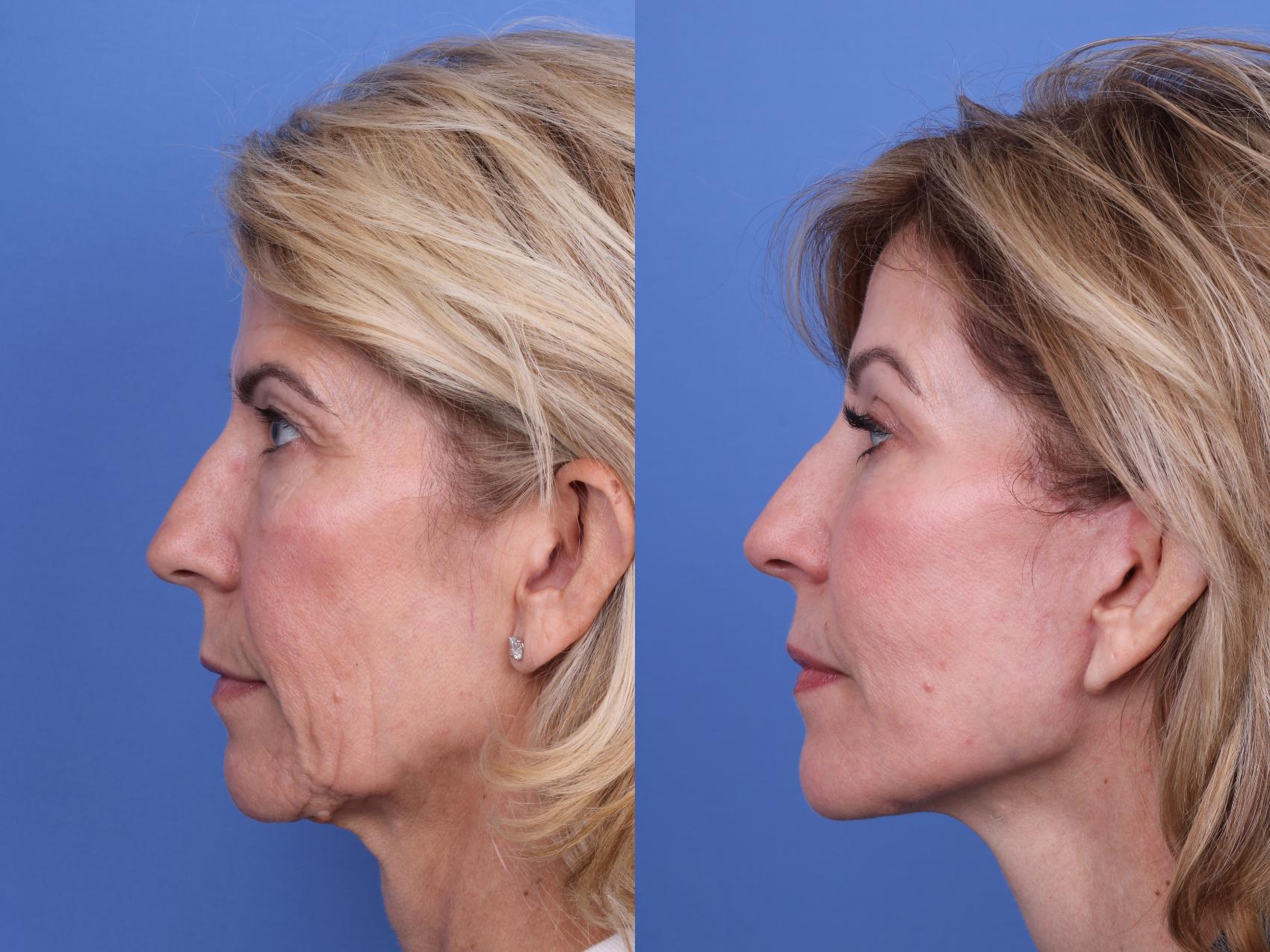 Before & After Facelift Case 695 Left Side View in Scottsdale, AZ
