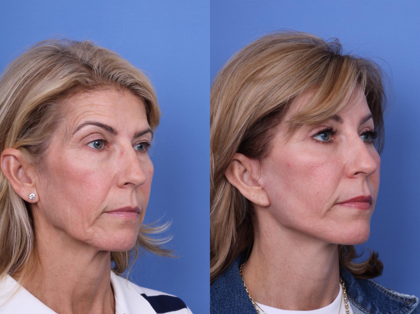 Before & After Facelift Case 695 Right Oblique View in Scottsdale, AZ