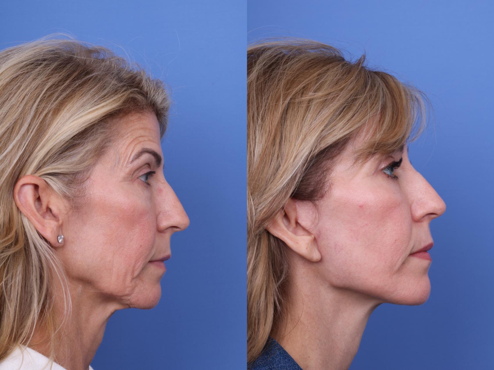 Before & After Facelift Case 695 Right Side View in Scottsdale, AZ