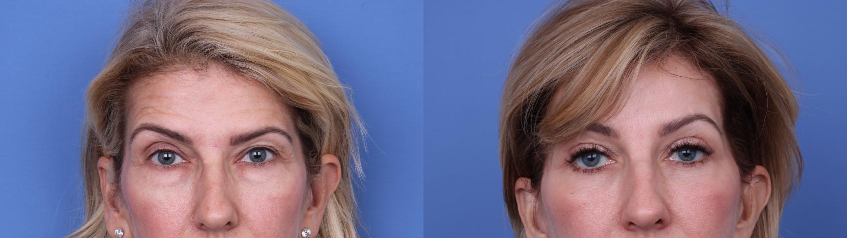 Before & After Facelift Case 695 Zoom Blepharoplasty View in Scottsdale, AZ
