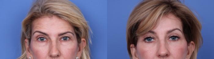 Before & After Facelift Case 695 Zoom Blepharoplasty View in Scottsdale, AZ
