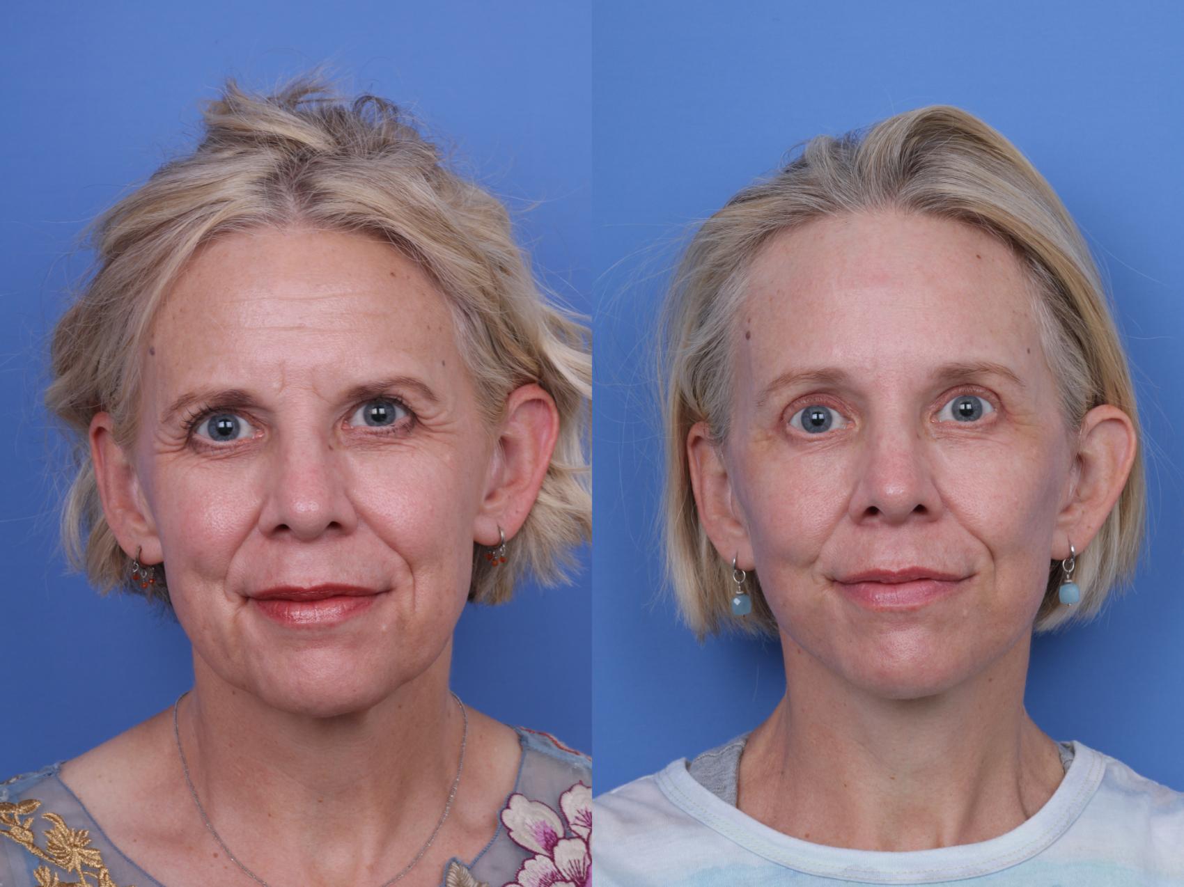 Before & After Facelift Case 696 Front View in Scottsdale, AZ