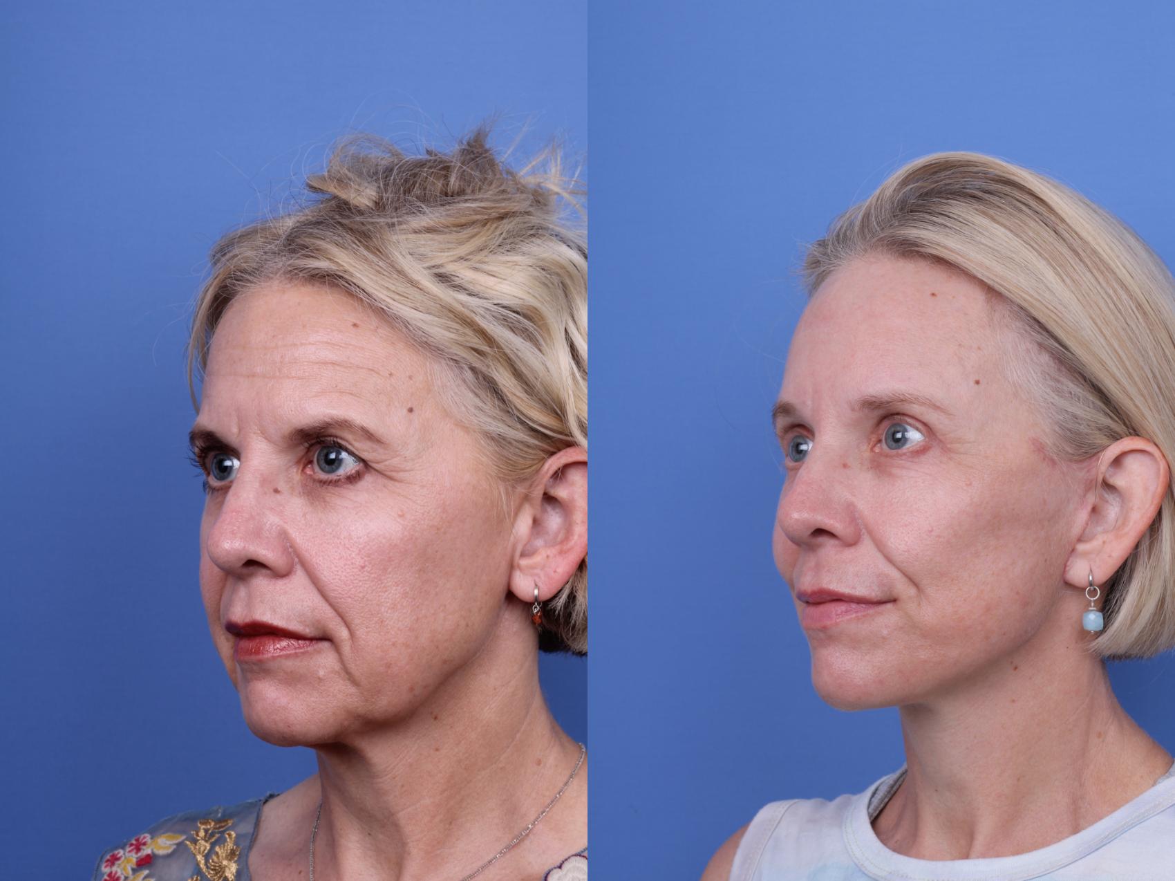 Before & After Facelift Case 696 Left Oblique View in Scottsdale, AZ