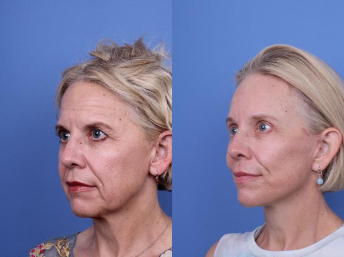 Before & After Facelift Case 696 Left Oblique View in Scottsdale, AZ