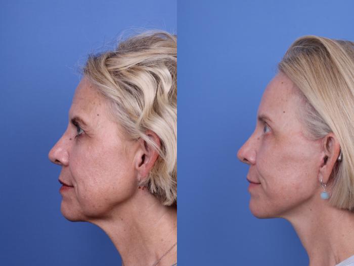 Before & After Facelift Case 696 Left Side View in Scottsdale, AZ