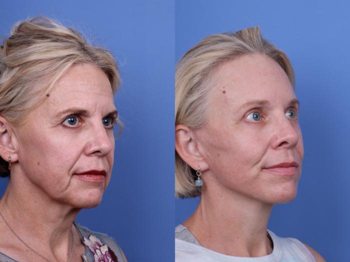 Before & After Facelift Case 696 Right Oblique View in Scottsdale, AZ