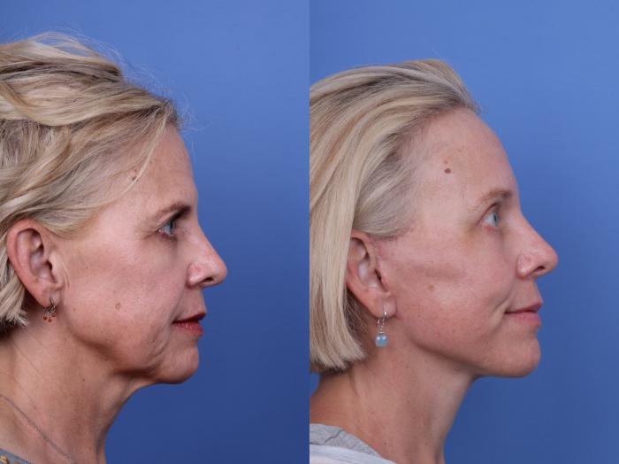 Before & After Facelift Case 696 Right Side View in Scottsdale, AZ