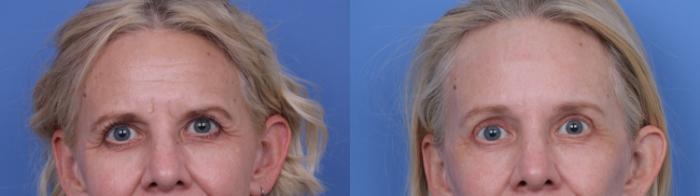 Before & After Facelift Case 696 Zoom Blepharoplasty View in Scottsdale, AZ