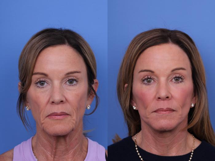 Before & After Facelift Case 697 Front View in Scottsdale, AZ