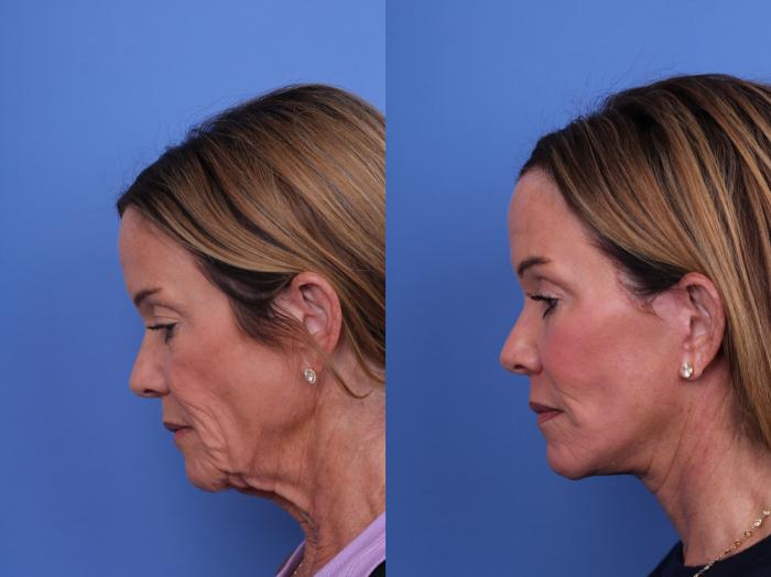 Before & After Facelift Case 697 Left Neck Flexion View in Scottsdale, AZ