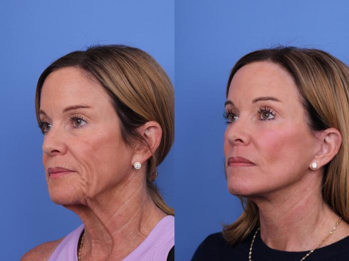 Before & After Facelift Case 697 Left Oblique View in Scottsdale, AZ