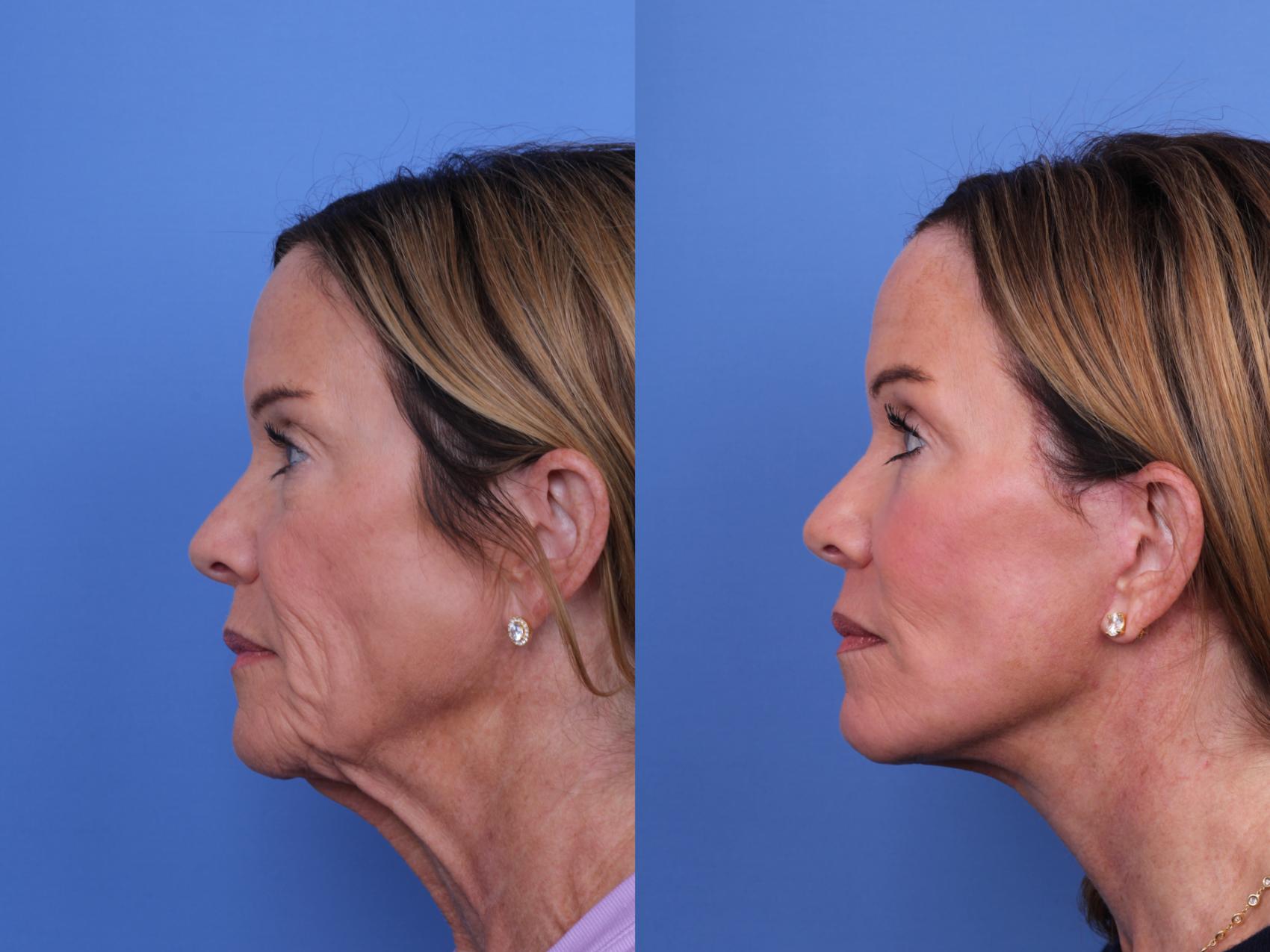 Before & After Facelift Case 697 Left Side View in Scottsdale, AZ