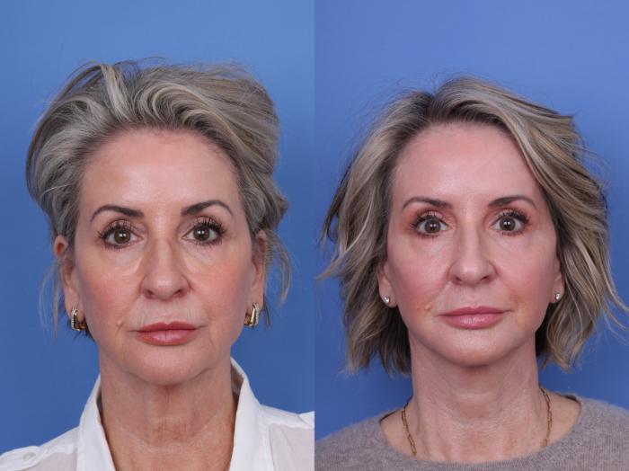 Before & After Facelift Case 699 Front View in Scottsdale, AZ