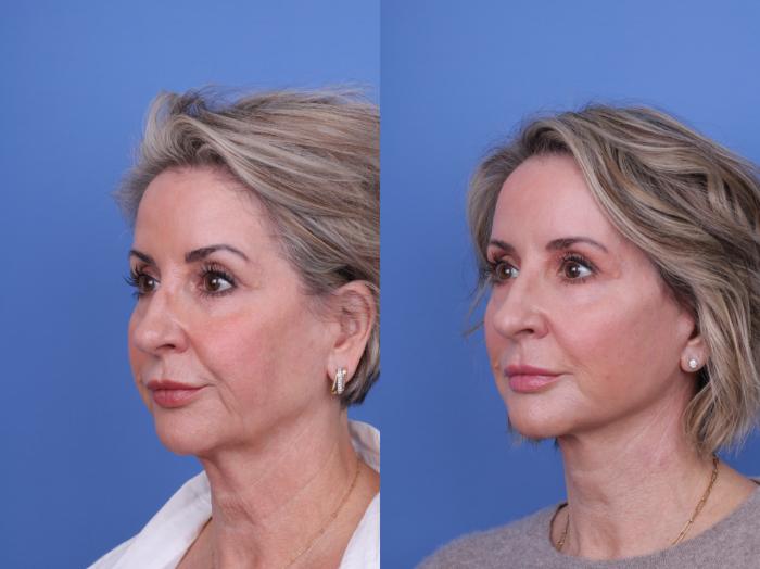 Before & After Facelift Case 699 Left Oblique View in Scottsdale, AZ