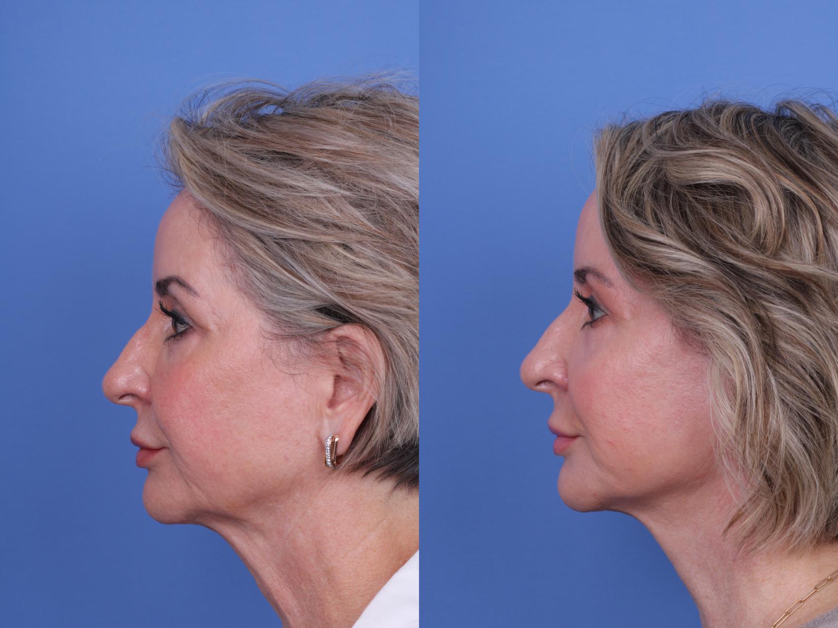 Before & After Facelift Case 699 Left Side View in Scottsdale, AZ