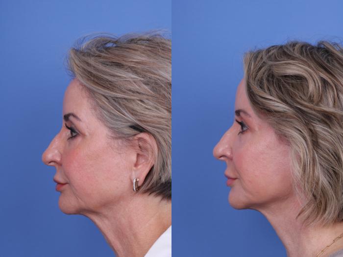 Before & After Facelift Case 699 Left Side View in Scottsdale, AZ