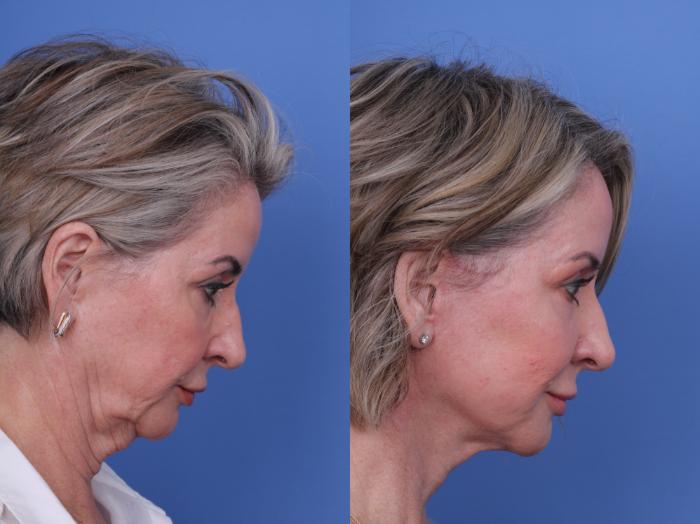 Before & After Facelift Case 699 Right Neck Flexion View in Scottsdale, AZ