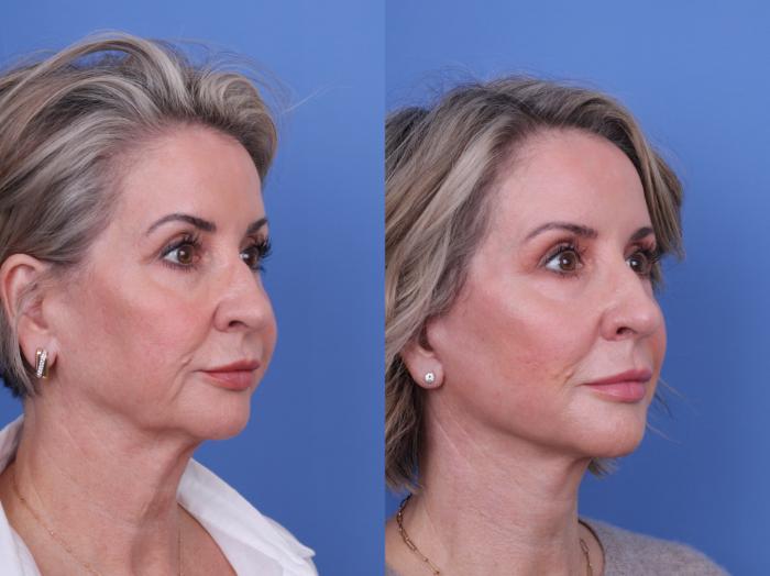 Before & After Facelift Case 699 Right Oblique View in Scottsdale, AZ