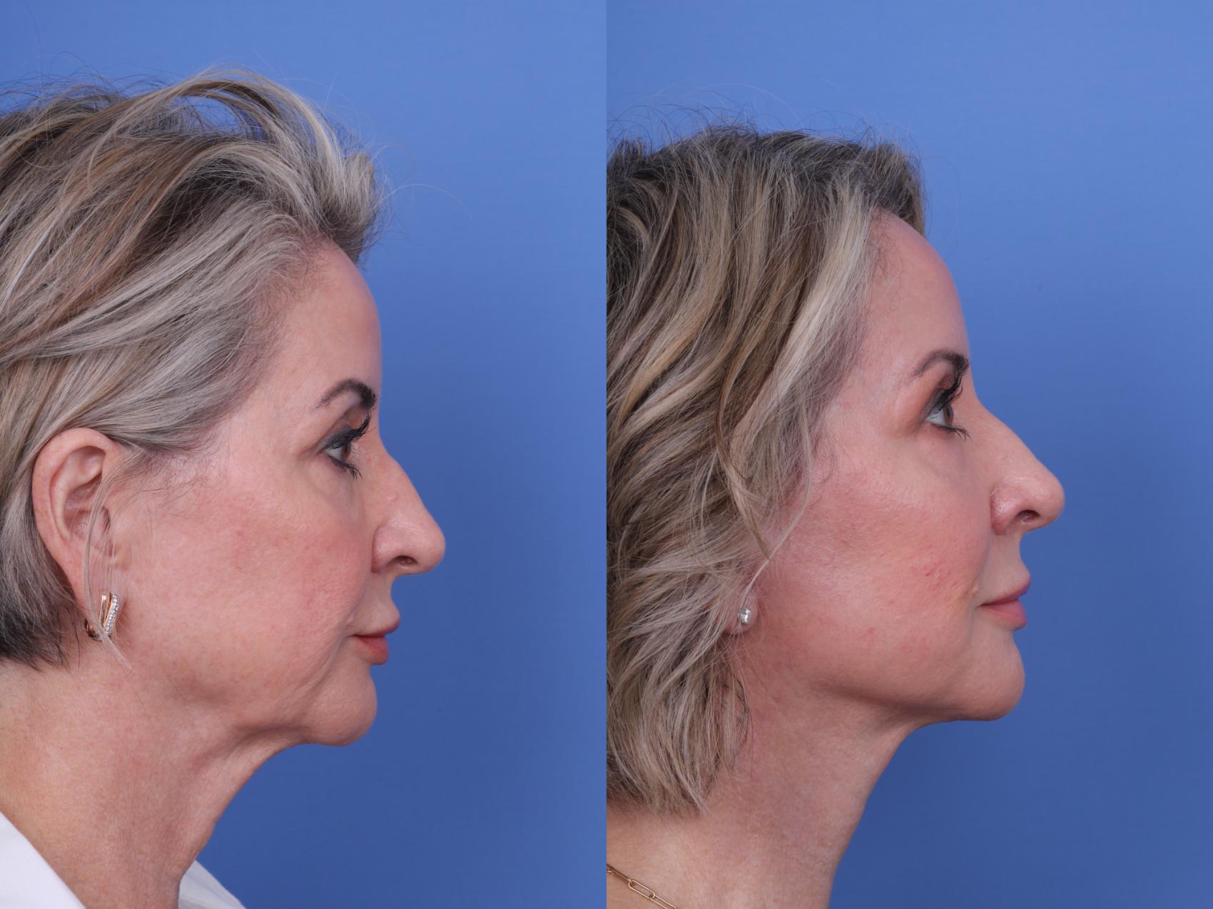 Before & After Facelift Case 699 Right Side View in Scottsdale, AZ