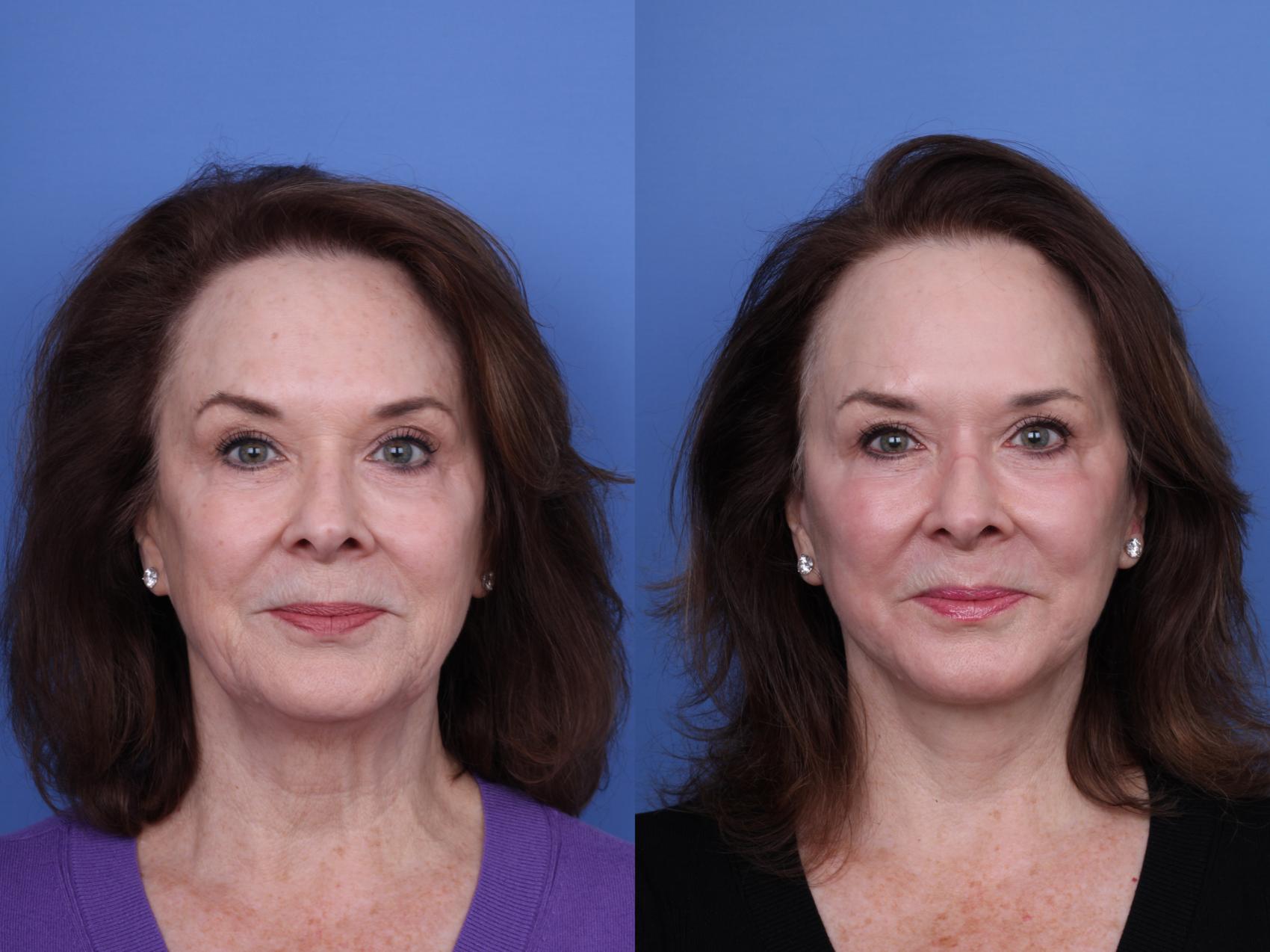 Before & After Facelift Case 704 Front View in Scottsdale, AZ