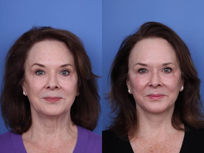 Before & After Facelift Case 704 Front View in Scottsdale, AZ