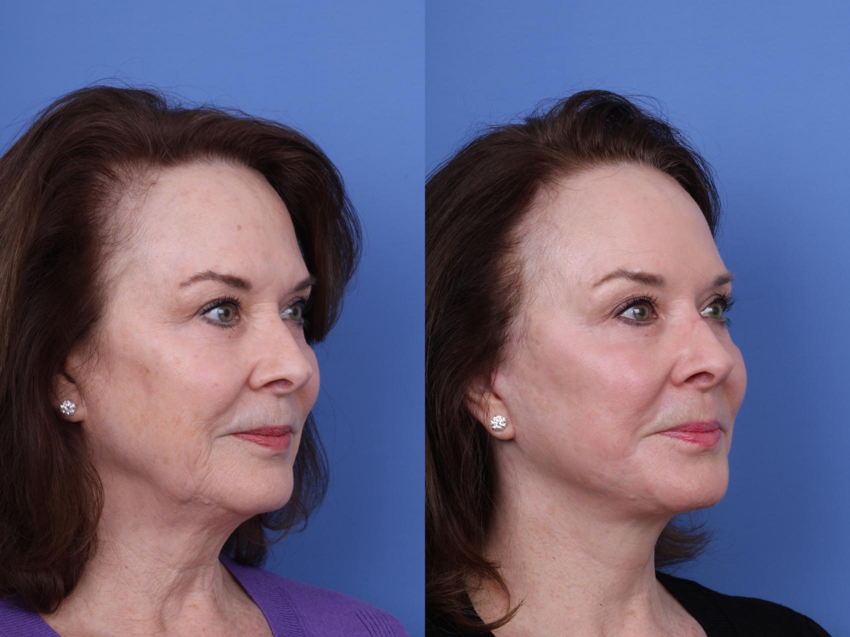 Before & After Facelift Case 704 Right Oblique View in Scottsdale, AZ