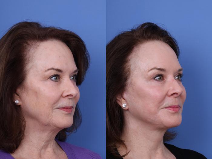 Before & After Facelift Case 704 Right Oblique View in Scottsdale, AZ