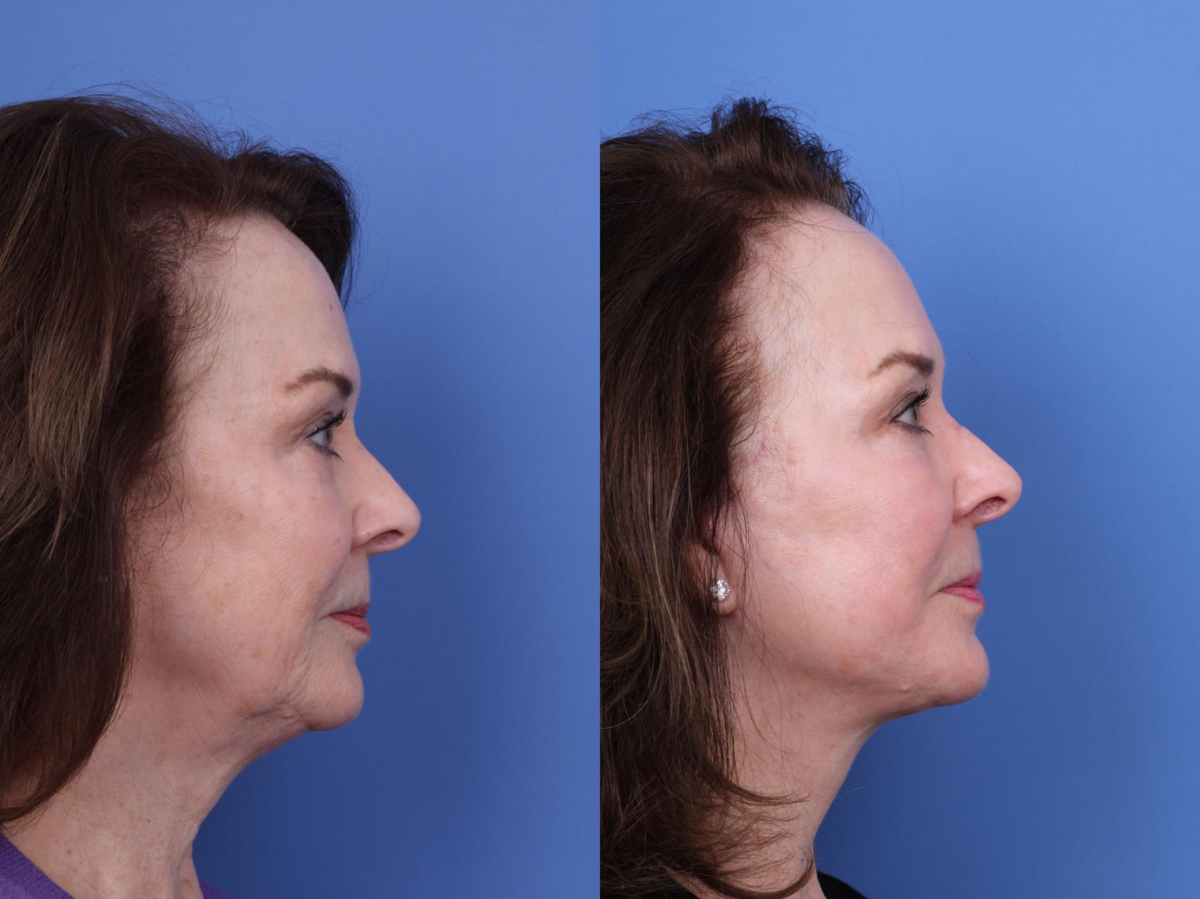 Before & After Facelift Case 704 Right Side View in Scottsdale, AZ