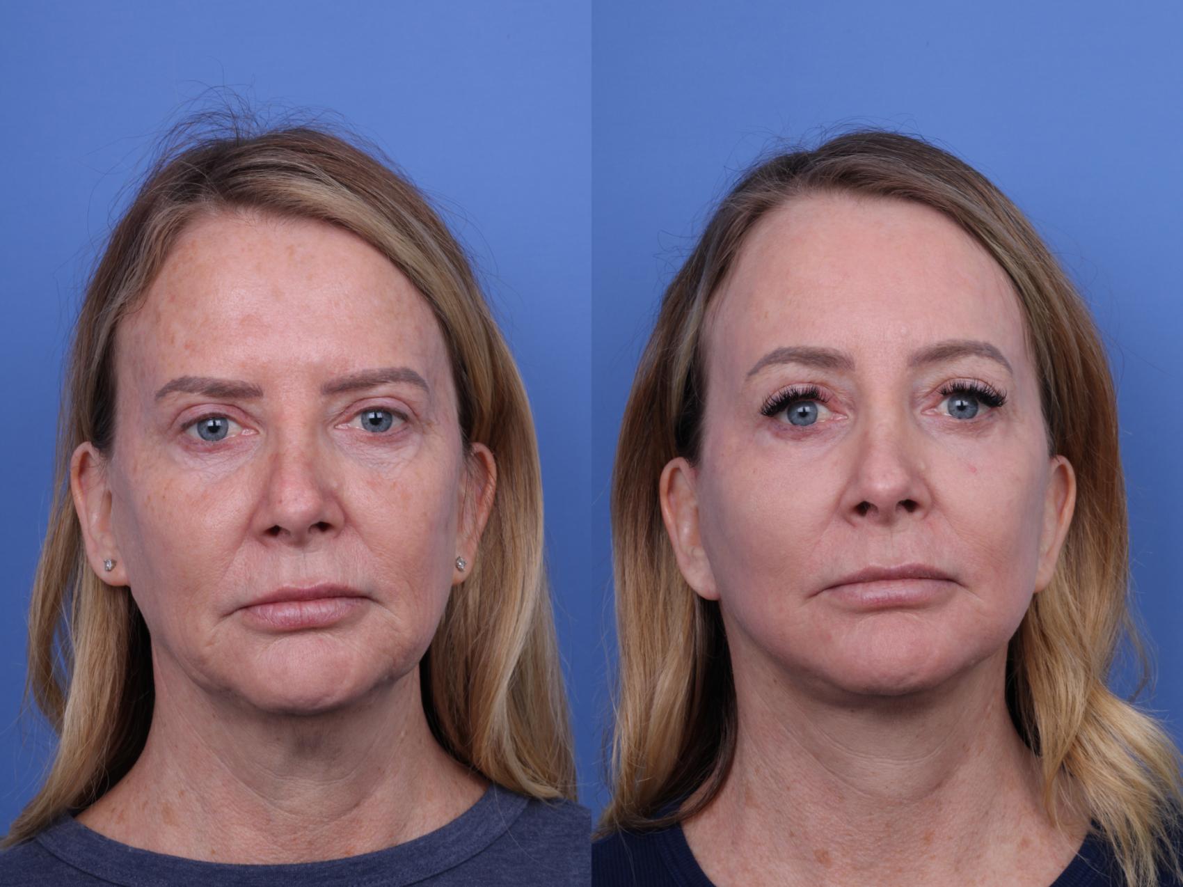 Before & After Facelift Case 709 Front View in Scottsdale, AZ