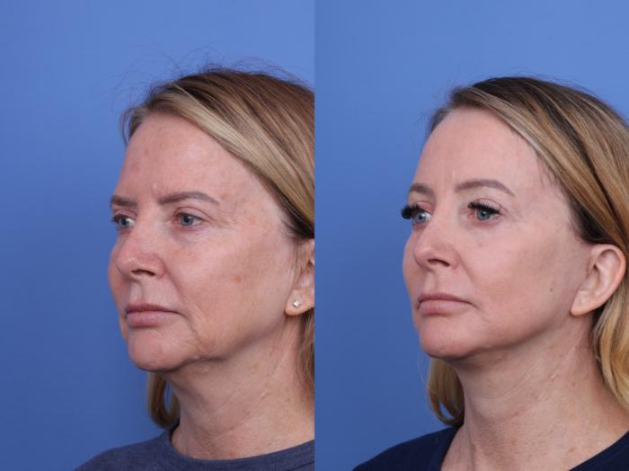 Before & After Facelift Case 709 Left Oblique View in Scottsdale, AZ