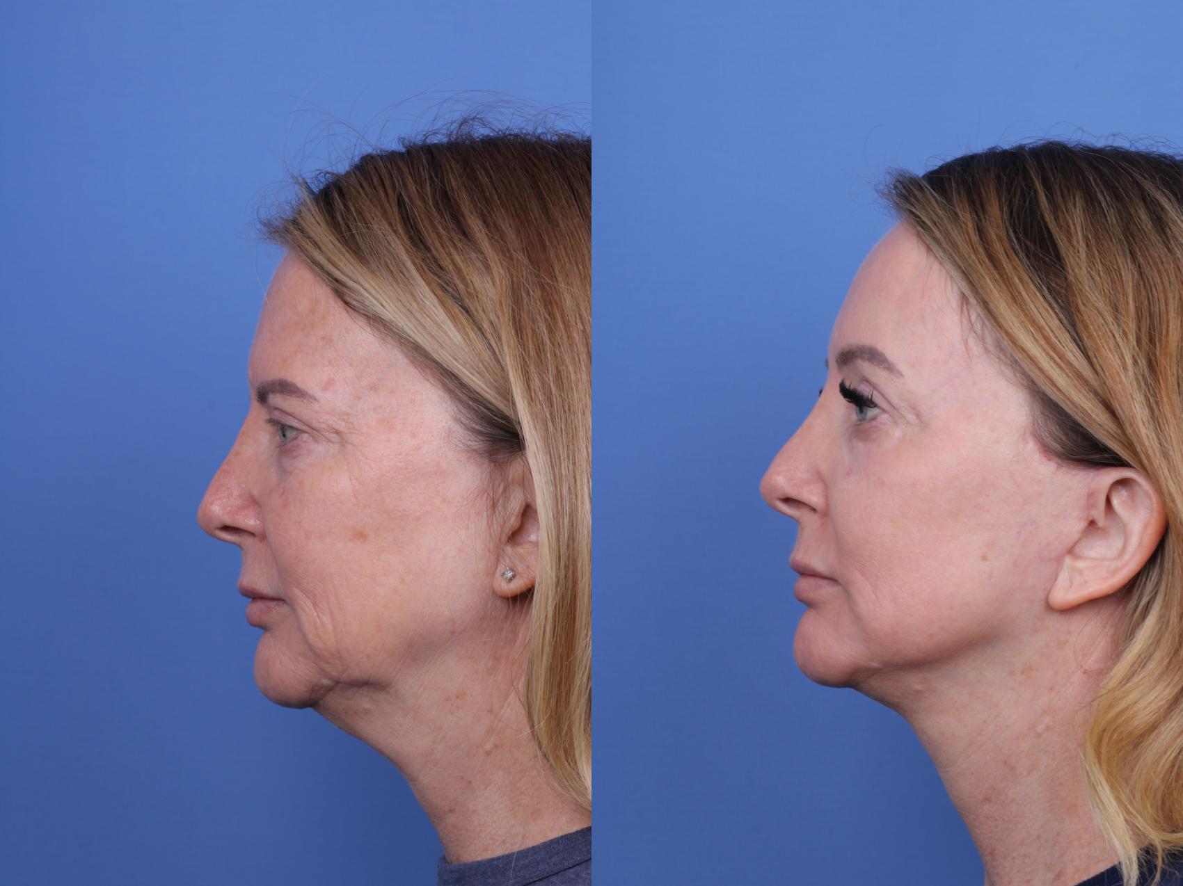 Before & After Facelift Case 709 Left Side View in Scottsdale, AZ