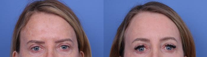 Before & After Facelift Case 709 Zoom Forehead Lift View in Scottsdale, AZ