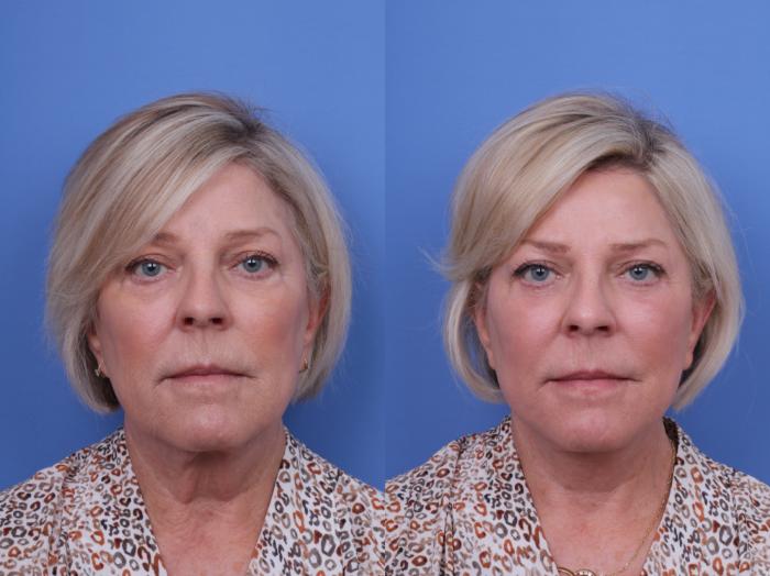 Before & After Blepharoplasty Case 710 Front View in Scottsdale, AZ