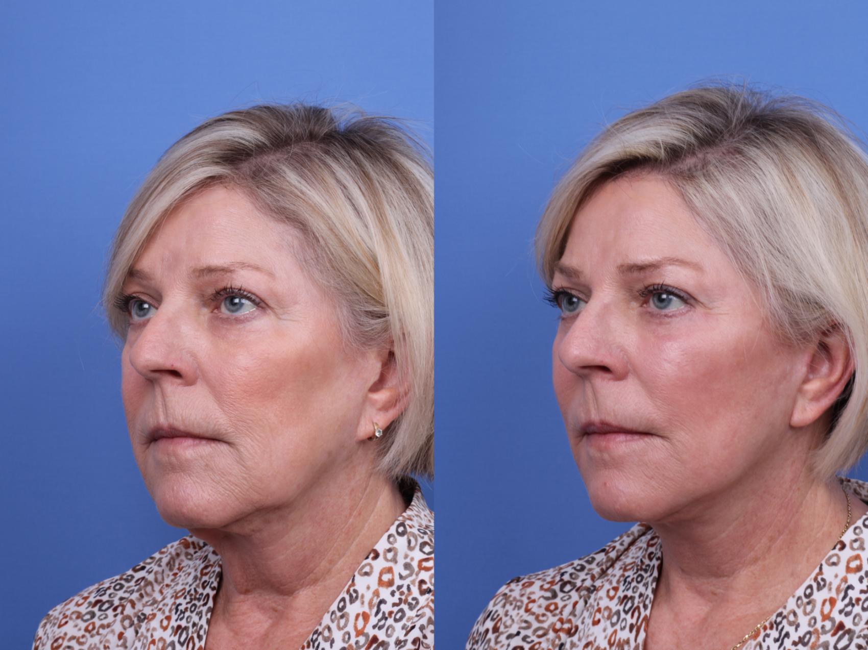 Before & After Blepharoplasty Case 710 Left Oblique View in Scottsdale, AZ