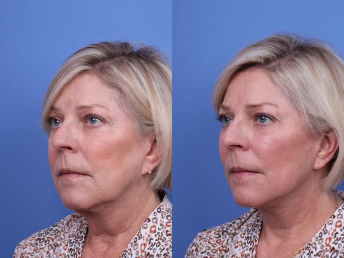 Before & After Blepharoplasty Case 710 Left Oblique View in Scottsdale, AZ