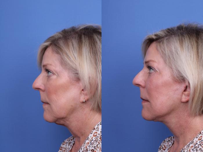 Before & After Blepharoplasty Case 710 Left Side View in Scottsdale, AZ