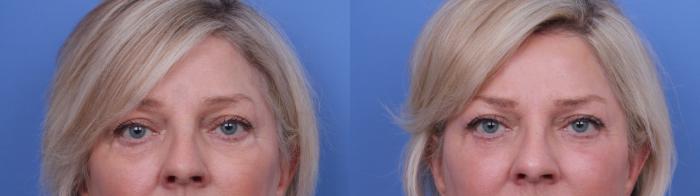 Before & After Blepharoplasty Case 710 Zoom Blepharoplasty View in Scottsdale, AZ