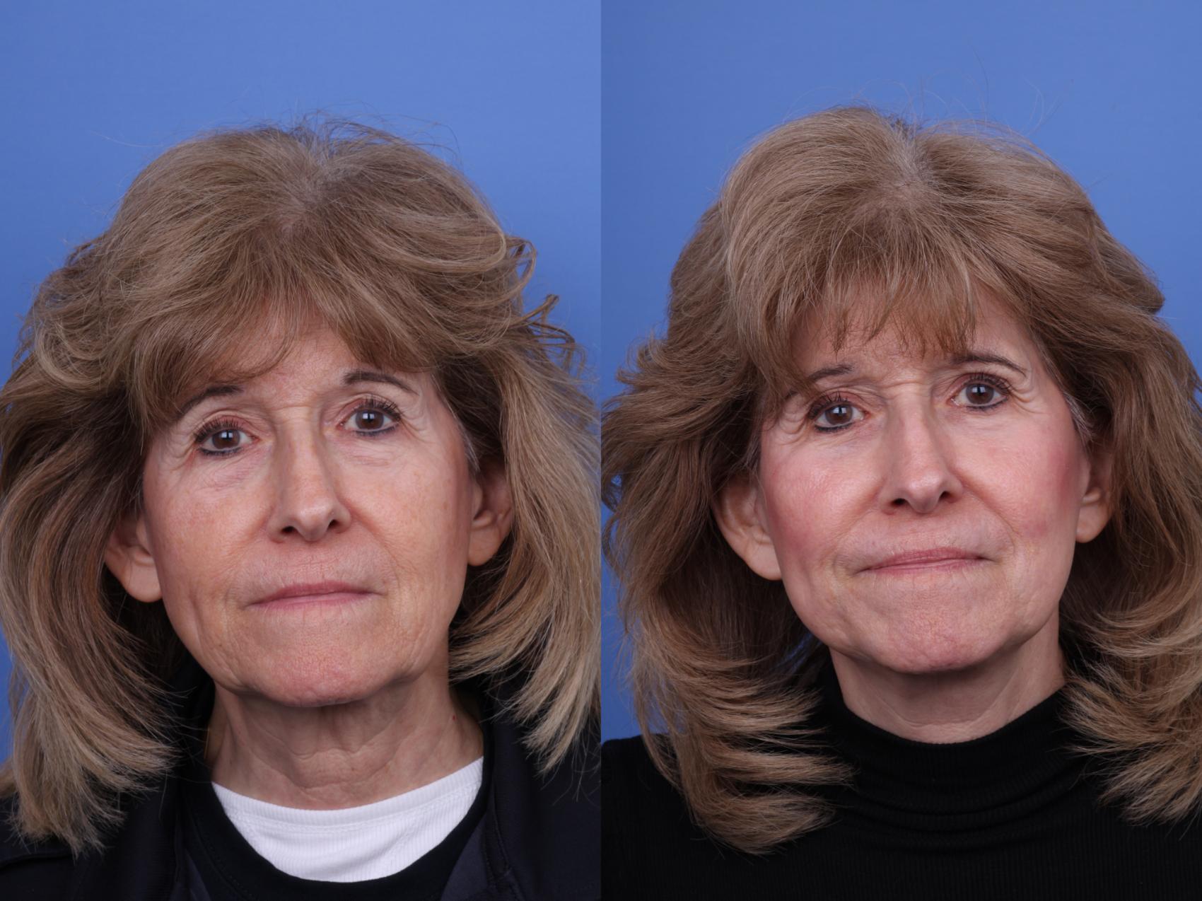 Before & After Blepharoplasty Case 711 Front View in Scottsdale, AZ