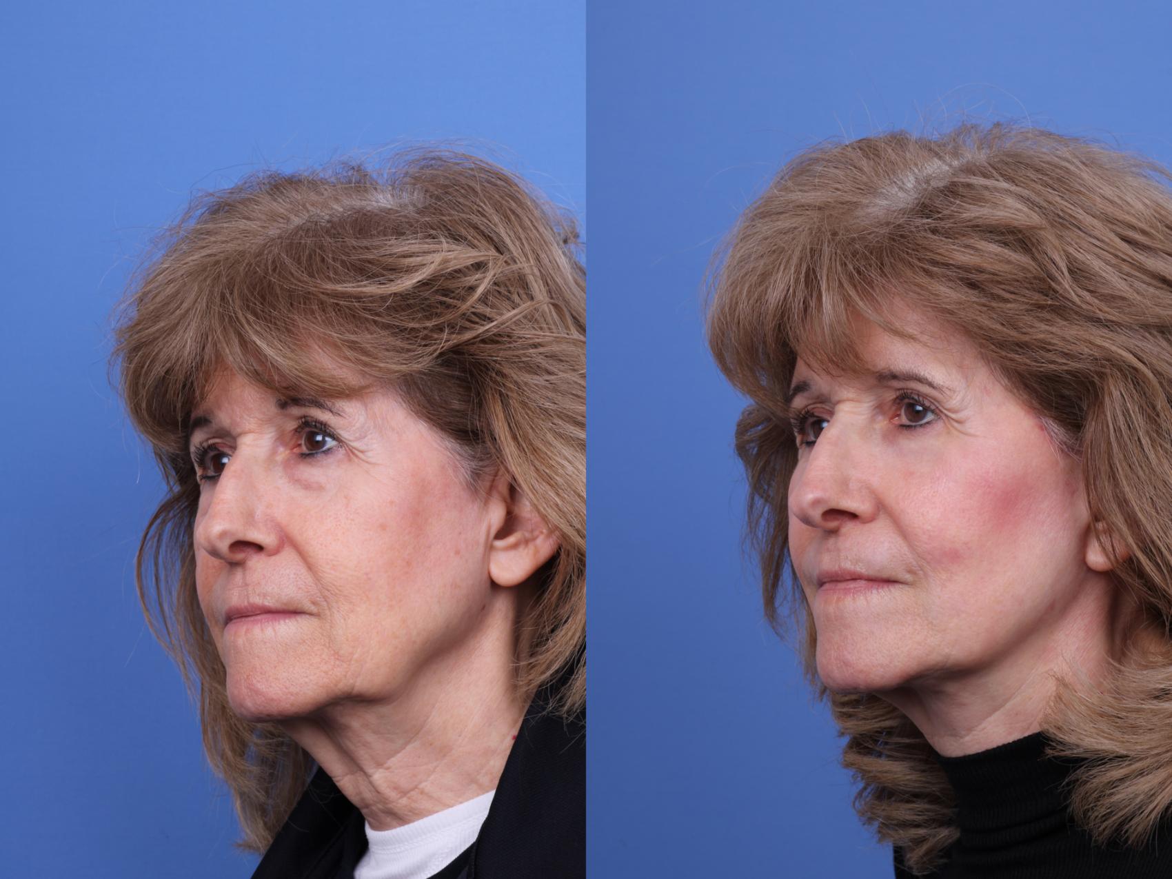 Before & After Blepharoplasty Case 711 Left Oblique View in Scottsdale, AZ