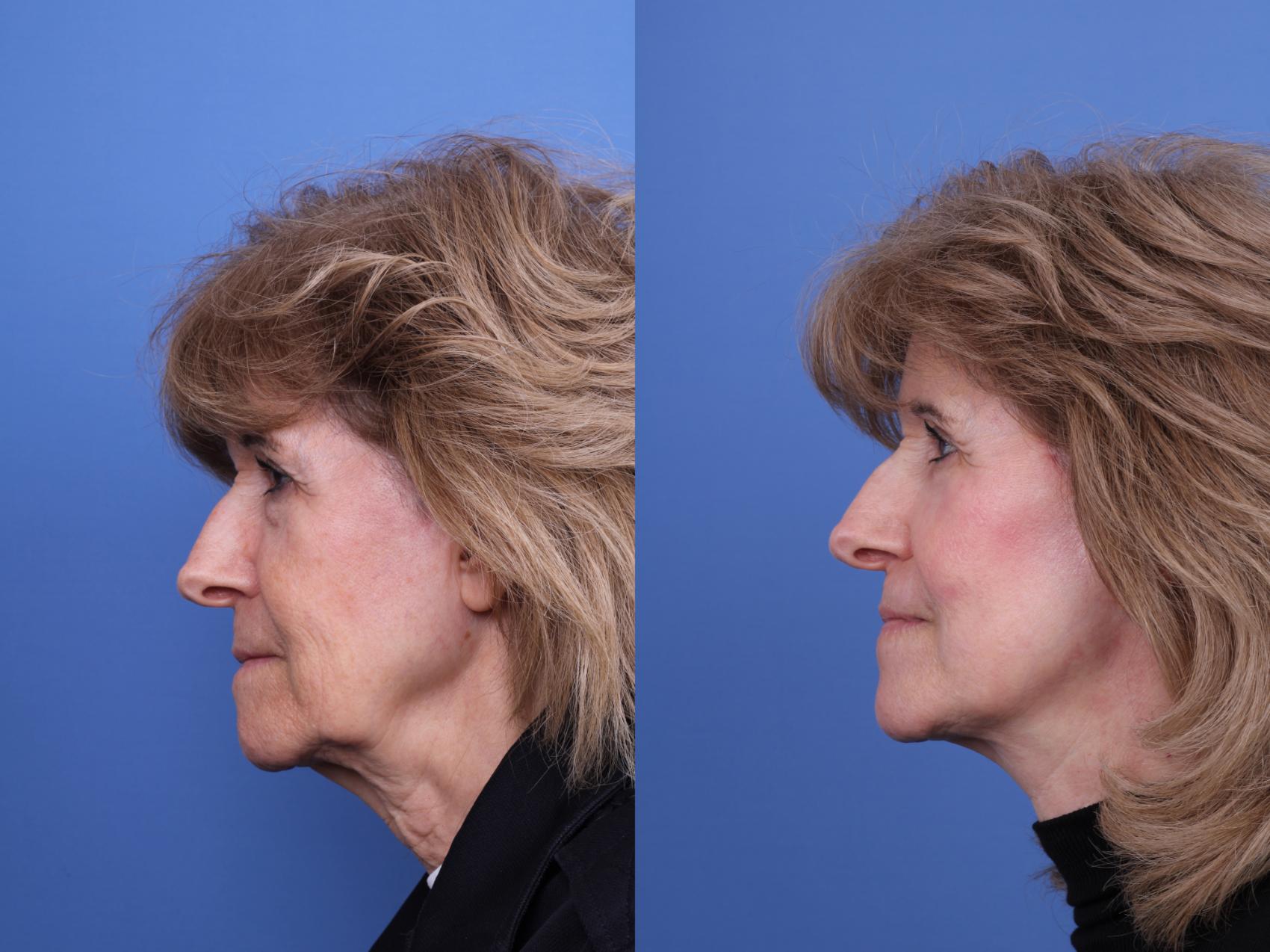 Before & After Blepharoplasty Case 711 Left Side View in Scottsdale, AZ