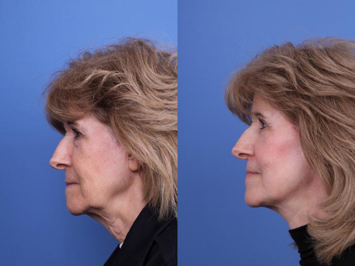 Before & After Blepharoplasty Case 711 Left Side View in Scottsdale, AZ