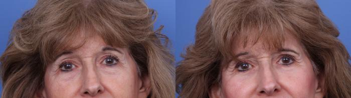 Before & After Blepharoplasty Case 711 Zoom Blepharoplasty View in Scottsdale, AZ