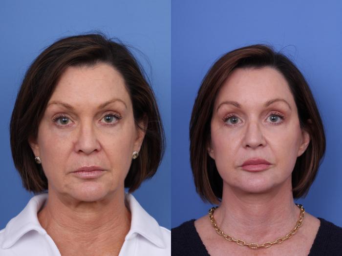 Before & After Blepharoplasty Case 712 Front View in Scottsdale, AZ