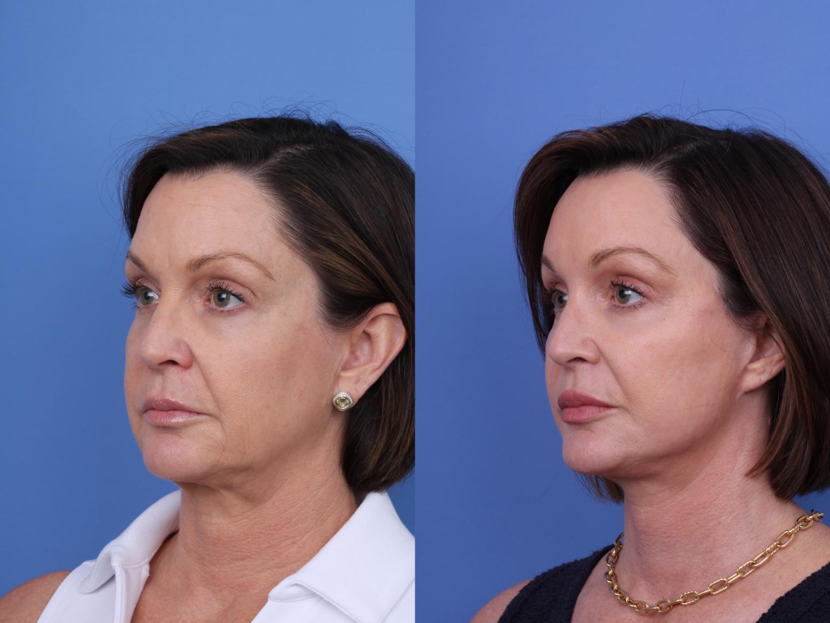 Before & After Blepharoplasty Case 712 Left Oblique View in Scottsdale, AZ