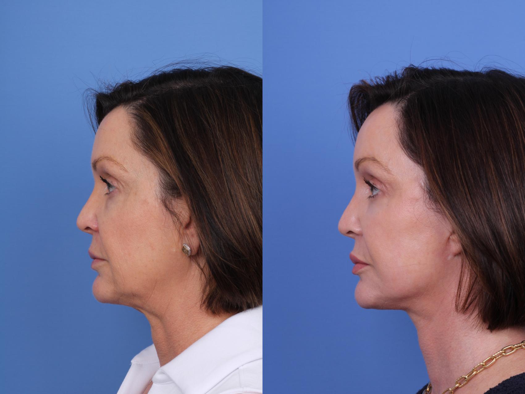Before & After Blepharoplasty Case 712 Left Side View in Scottsdale, AZ