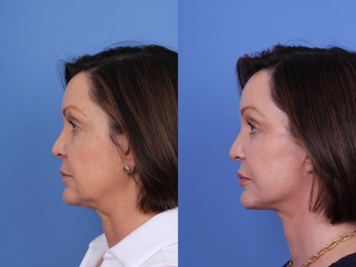Before & After Blepharoplasty Case 712 Left Side View in Scottsdale, AZ