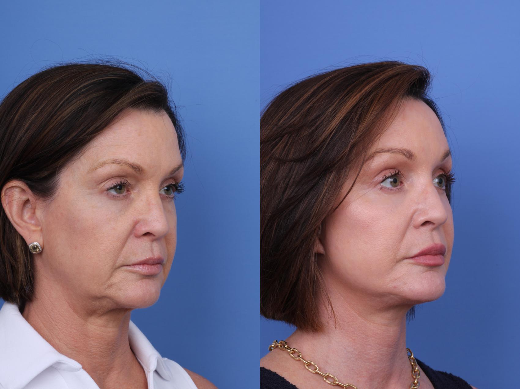 Before & After Blepharoplasty Case 712 Right Oblique View in Scottsdale, AZ